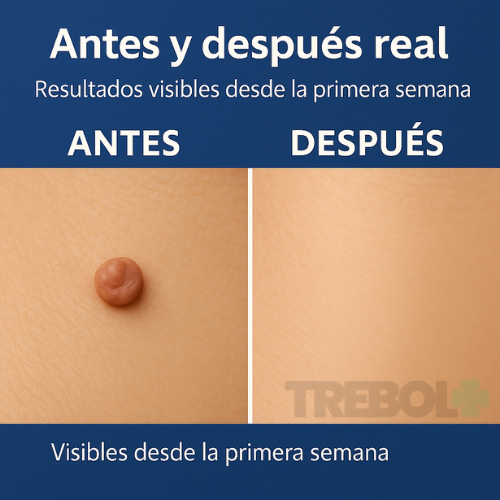 Removedor de Verrugas Natural WartPro Remover®